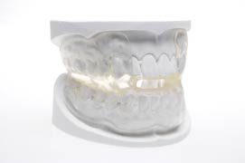 Schnarchschiene (© Dr. Hinz KFO-Labor)